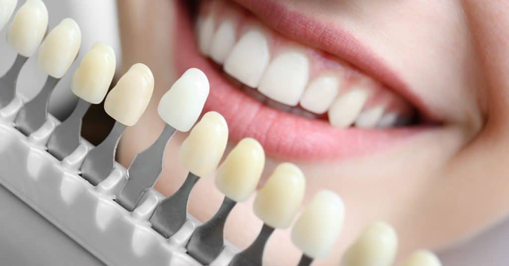 Teeth Whitening - Shoal Creek Smile Studio