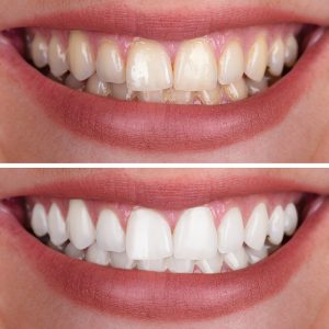Teeth Whitening - Shoal Creek Smile Studio