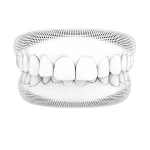 Overbite
