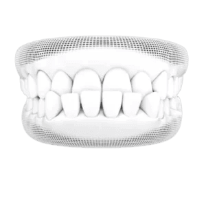Underbite